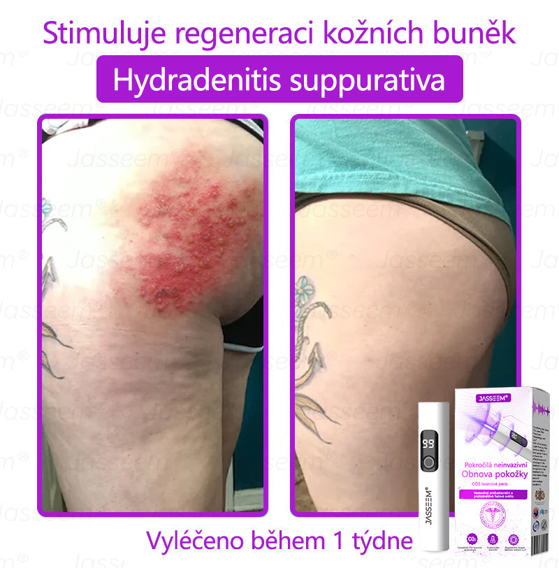 🌿𝐉𝐚𝐬𝐬𝐞𝐞𝐦® Pokročilé neinvazivní pero s CO₂ laserem na opravu pokožky 💕 (šetrně odstraňuje bradavice, mateřská znaménka, stařecké skvrny a kožní značky - bez bolesti a rozruchu!)🌿