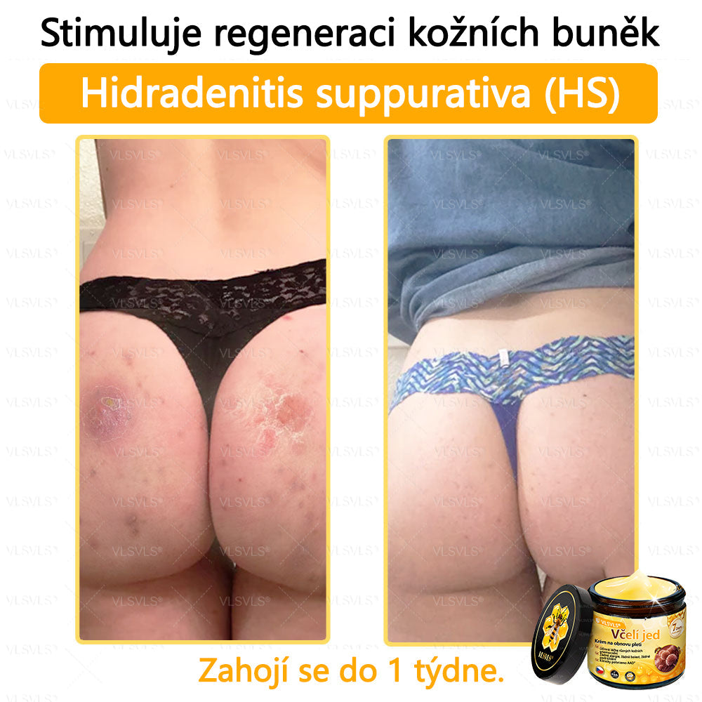 🐝VLSVLS™ Krém s včelím jedem – doporučeno kožními lékaři 🧑⚕️ Na různé kožní problémy – fakt účinný a šetrný pomocník🍃