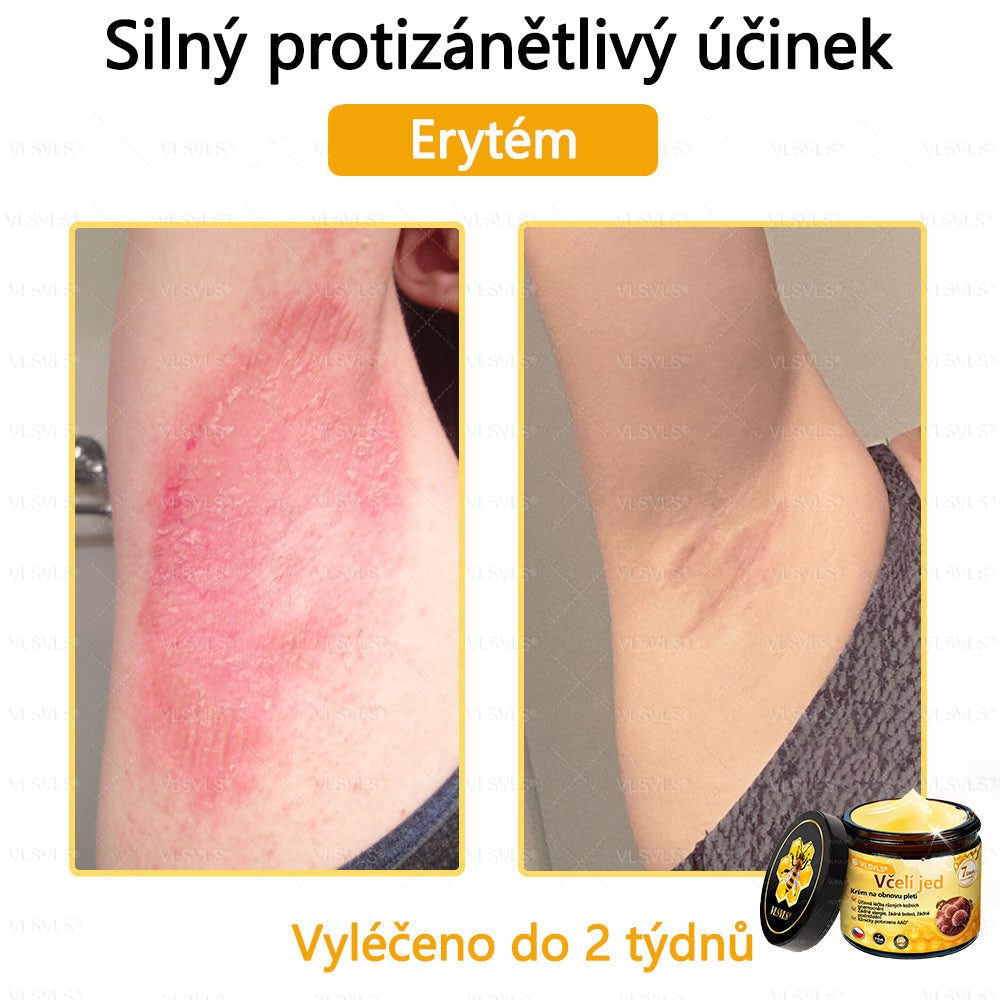 🐝VLSVLS™ Krém s včelím jedem – doporučeno kožními lékaři 🧑⚕️ Na různé kožní problémy – fakt účinný a šetrný pomocník🍃