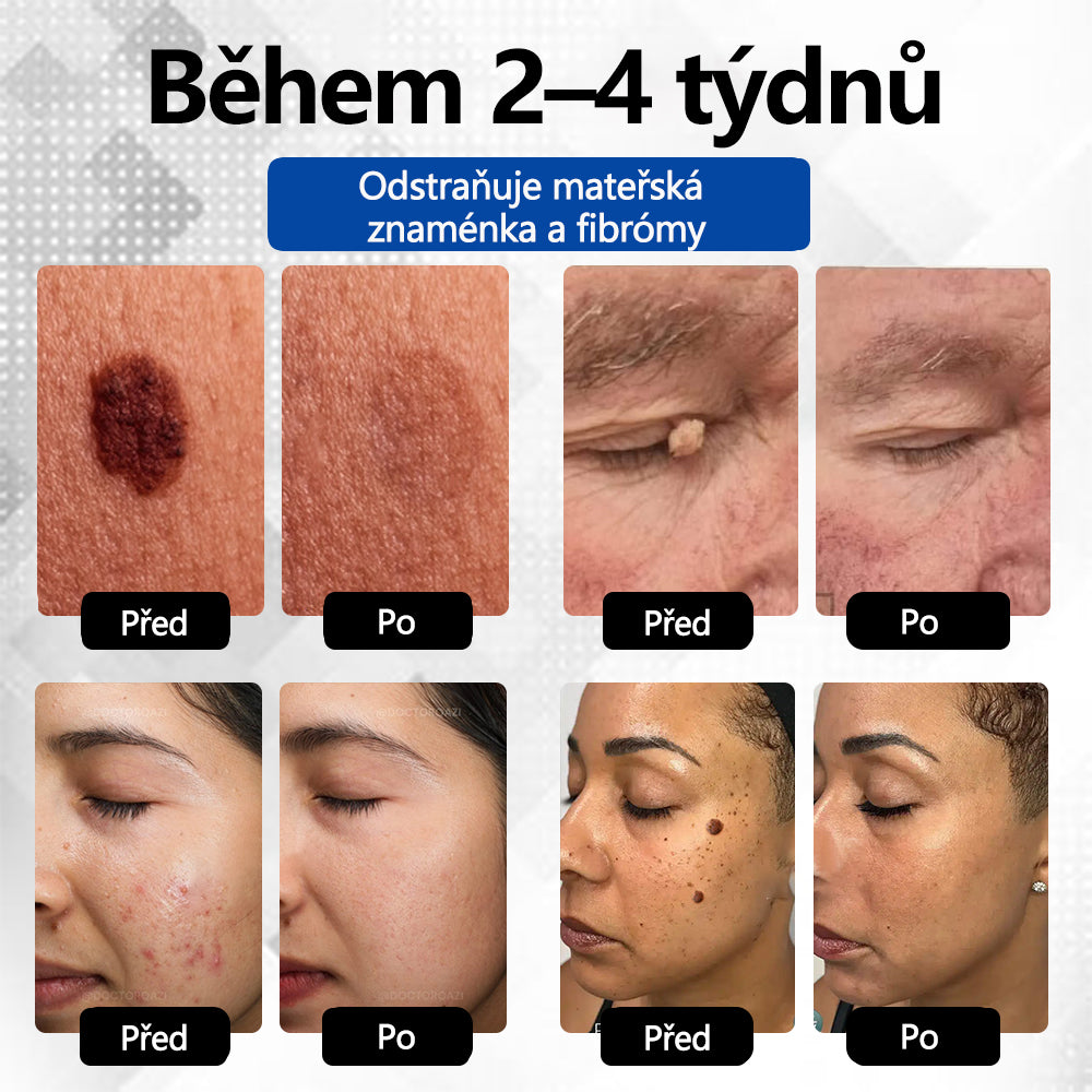 RICPIND® DermaLite laserové pero na odstranění mateřských znamének a bradavic