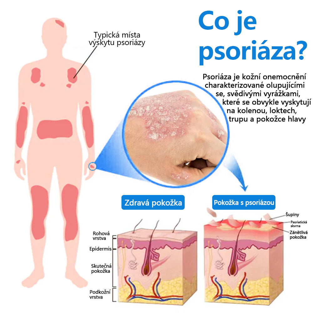 ✅ Oficiální obchod: Zvoevo® Magnesium bylinný sprej na lupénku ⚕️ EMA certifikace (zmírňuje lupénku a ekzém, léčí akné a bradavice, podporuje hojení bakteriálních infekcí, snižuje kloubní a neuropatickou bolest)