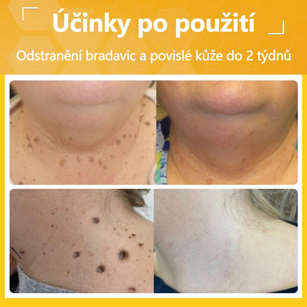 Twinsun™ Extra Silný Krém s včelím jedem, certifikovaný EMA💖 Na ošetření bradavic, kožních výrůstků, infekcí a keratózy, vyhlazuje nerovnoměrný povrch pokožky🐝