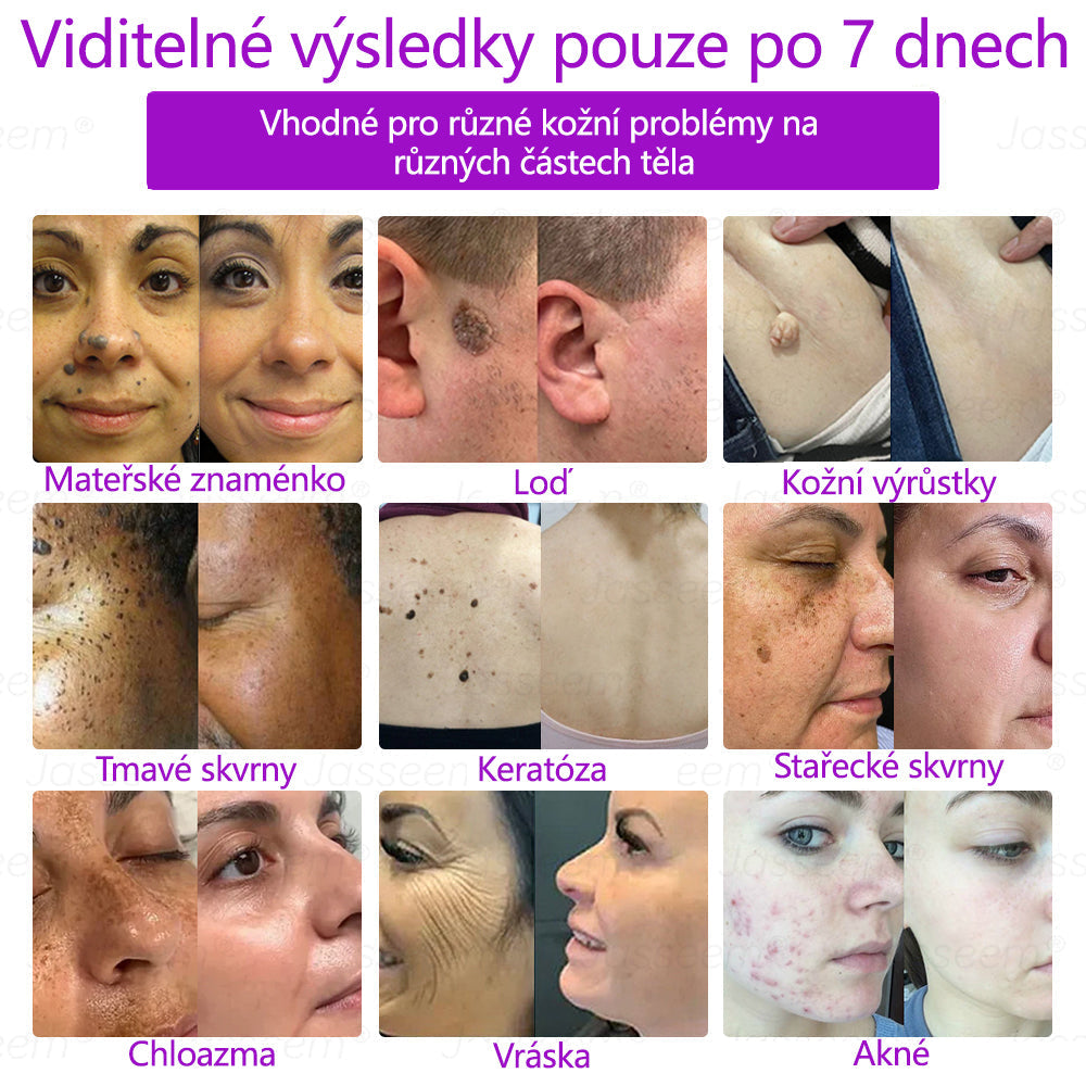 🌿𝐉𝐚𝐬𝐬𝐞𝐞𝐦® Pokročilé neinvazivní pero s CO₂ laserem na opravu pokožky 💕 (šetrně odstraňuje bradavice, mateřská znaménka, stařecké skvrny a kožní značky - bez bolesti a rozruchu!)🌿