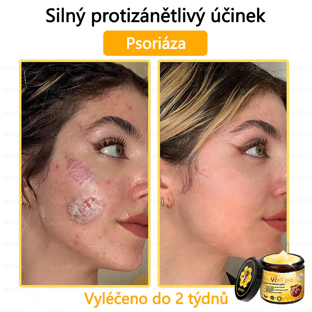 🐝VLSVLS™ Krém s včelím jedem – doporučeno kožními lékaři 🧑⚕️ Na různé kožní problémy – fakt účinný a šetrný pomocník🍃