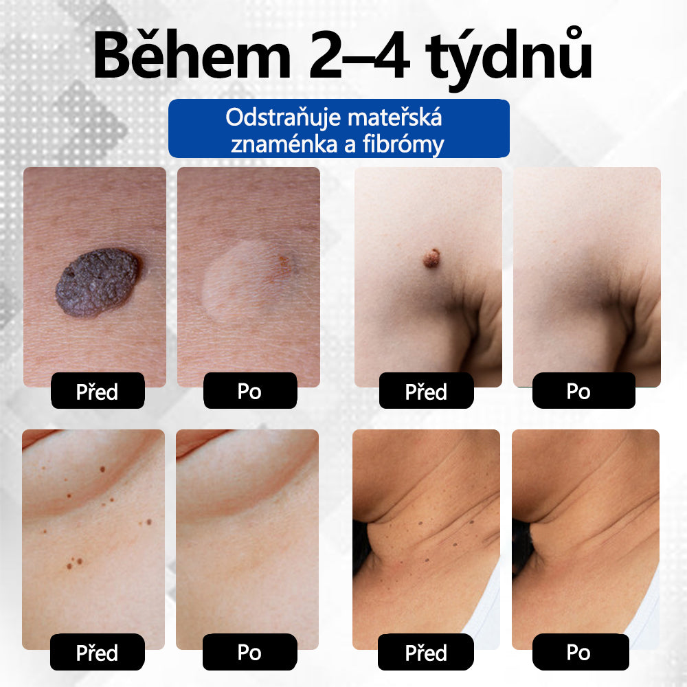 RICPIND® DermaLite laserové pero na odstranění mateřských znamének a bradavic