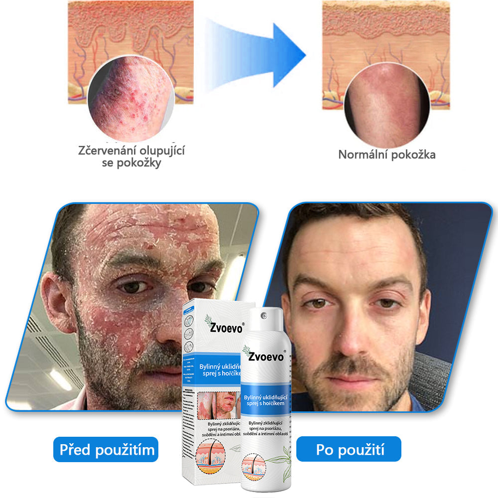 ✅ Oficiální obchod: Zvoevo® Magnesium bylinný sprej na lupénku ⚕️ EMA certifikace (zmírňuje lupénku a ekzém, léčí akné a bradavice, podporuje hojení bakteriálních infekcí, snižuje kloubní a neuropatickou bolest)