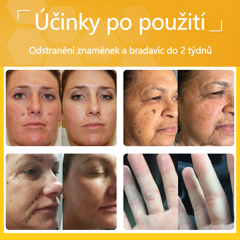 Twinsun™ Extra Silný Krém s včelím jedem, certifikovaný EMA💖 Na ošetření bradavic, kožních výrůstků, infekcí a keratózy, vyhlazuje nerovnoměrný povrch pokožky🐝