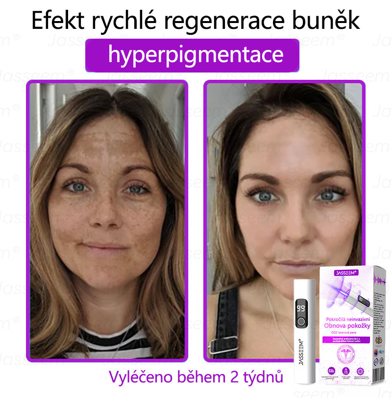 🌿𝐉𝐚𝐬𝐬𝐞𝐞𝐦® Pokročilé neinvazivní pero s CO₂ laserem na opravu pokožky 💕 (šetrně odstraňuje bradavice, mateřská znaménka, stařecké skvrny a kožní značky - bez bolesti a rozruchu!)🌿