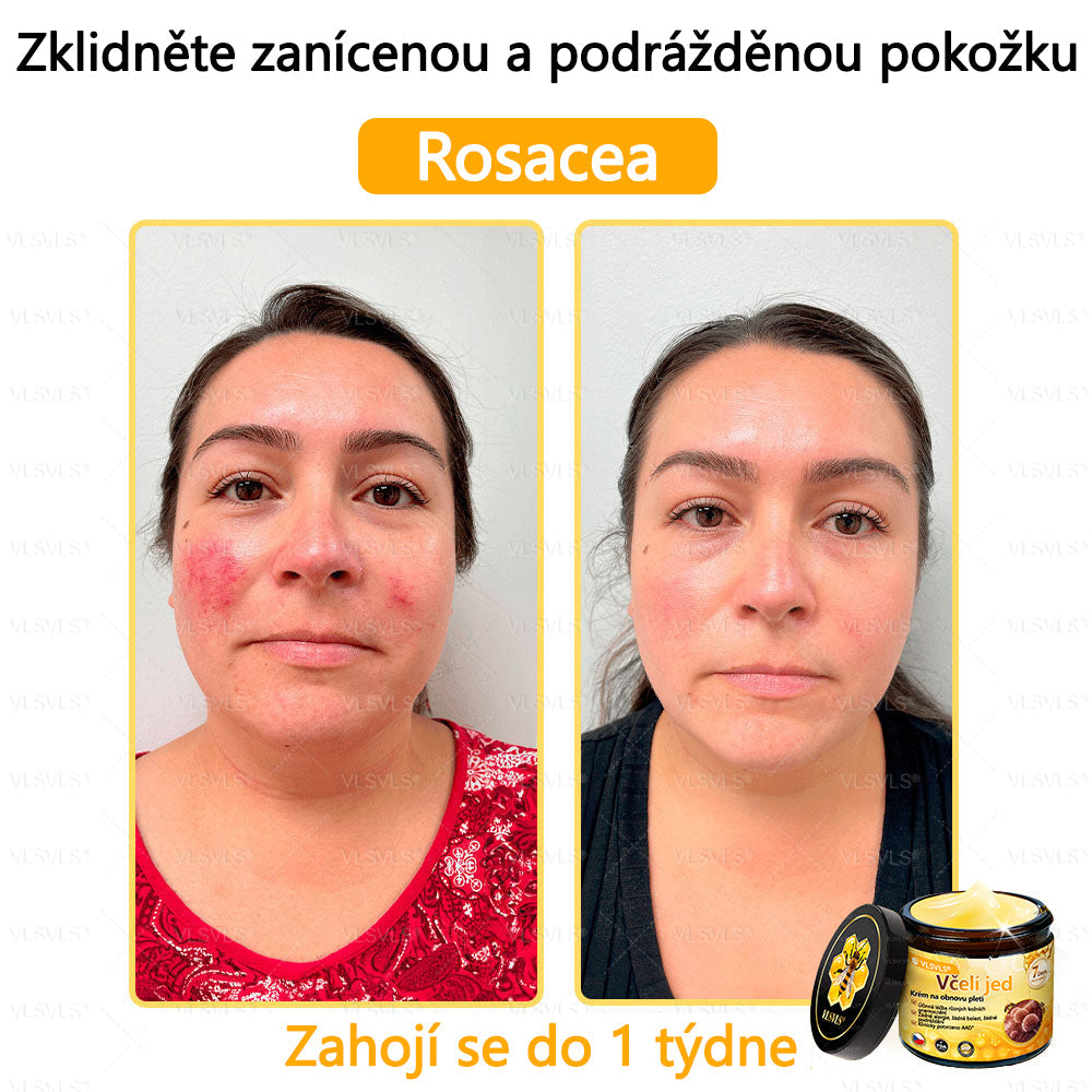 🐝VLSVLS™ Krém s včelím jedem – doporučeno kožními lékaři 🧑⚕️ Na různé kožní problémy – fakt účinný a šetrný pomocník🍃