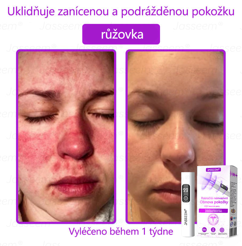 🌿𝐉𝐚𝐬𝐬𝐞𝐞𝐦® Pokročilé neinvazivní pero s CO₂ laserem na opravu pokožky 💕 (šetrně odstraňuje bradavice, mateřská znaménka, stařecké skvrny a kožní značky - bez bolesti a rozruchu!)🌿