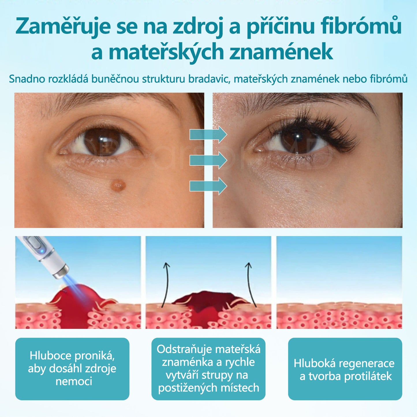 RICPIND® DermaLite laserové pero na odstranění mateřských znamének a bradavic