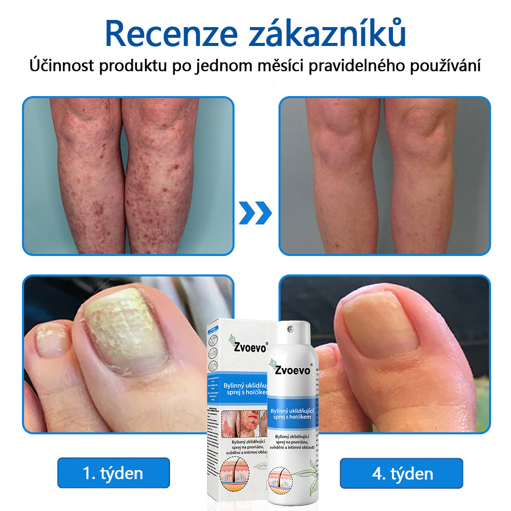 ✅ Oficiální obchod: Zvoevo® Magnesium bylinný sprej na lupénku ⚕️ EMA certifikace (zmírňuje lupénku a ekzém, léčí akné a bradavice, podporuje hojení bakteriálních infekcí, snižuje kloubní a neuropatickou bolest)
