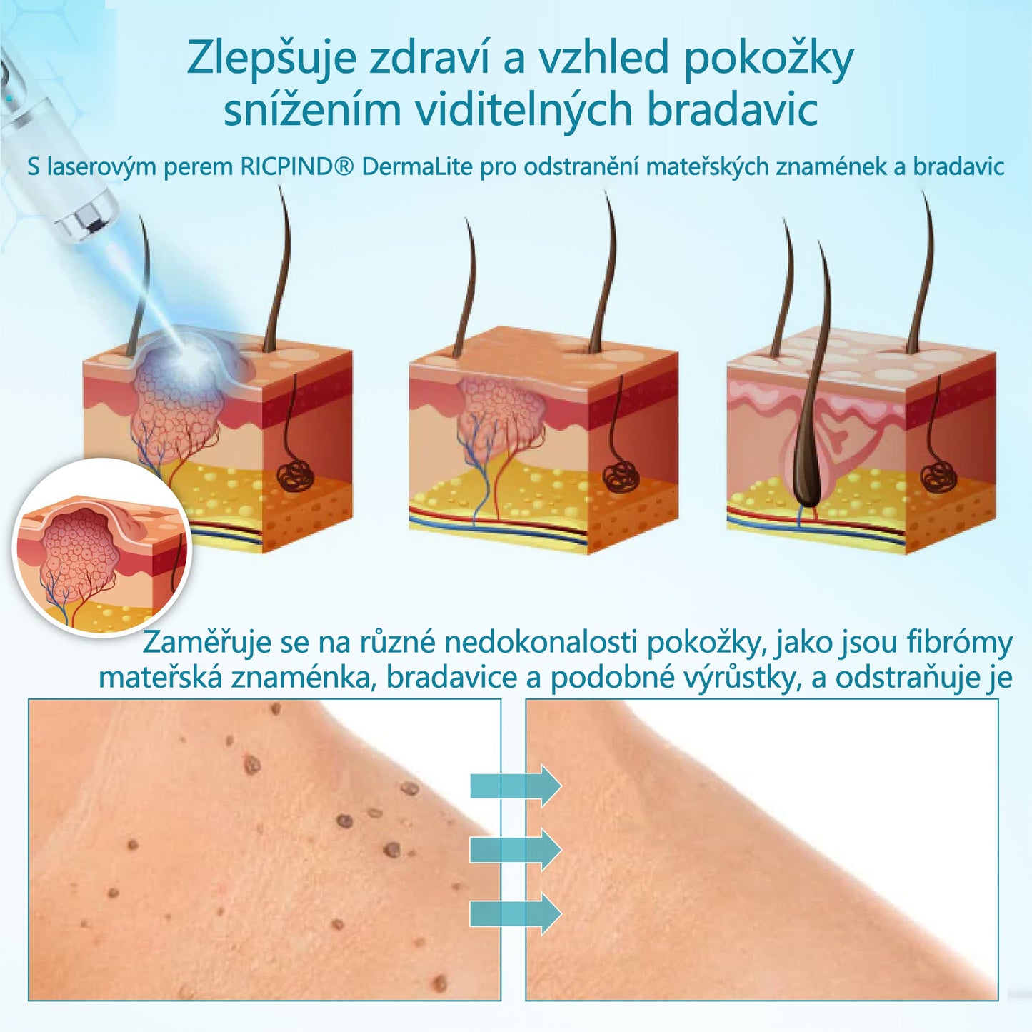 RICPIND® DermaLite laserové pero na odstranění mateřských znamének a bradavic