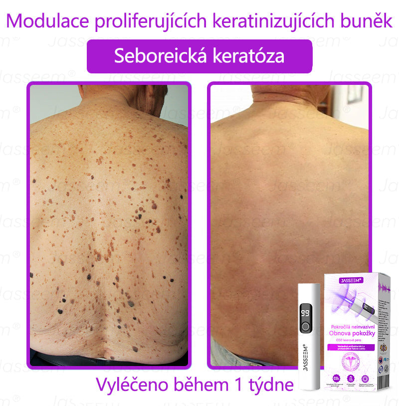 🌿𝐉𝐚𝐬𝐬𝐞𝐞𝐦® Pokročilé neinvazivní pero s CO₂ laserem na opravu pokožky 💕 (šetrně odstraňuje bradavice, mateřská znaménka, stařecké skvrny a kožní značky - bez bolesti a rozruchu!)🌿
