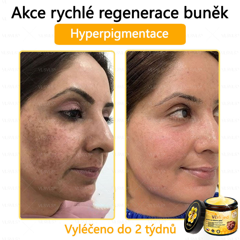 🐝VLSVLS™ Krém s včelím jedem – doporučeno kožními lékaři 🧑⚕️ Na různé kožní problémy – fakt účinný a šetrný pomocník🍃
