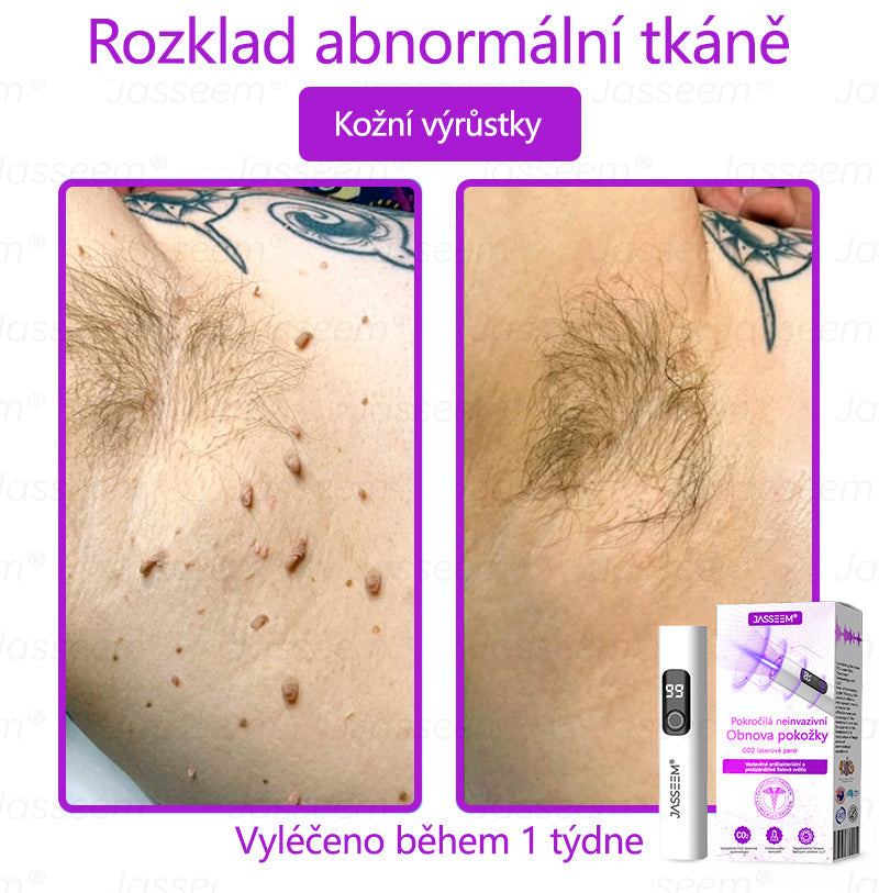 🌿𝐉𝐚𝐬𝐬𝐞𝐞𝐦® Pokročilé neinvazivní pero s CO₂ laserem na opravu pokožky 💕 (šetrně odstraňuje bradavice, mateřská znaménka, stařecké skvrny a kožní značky - bez bolesti a rozruchu!)🌿