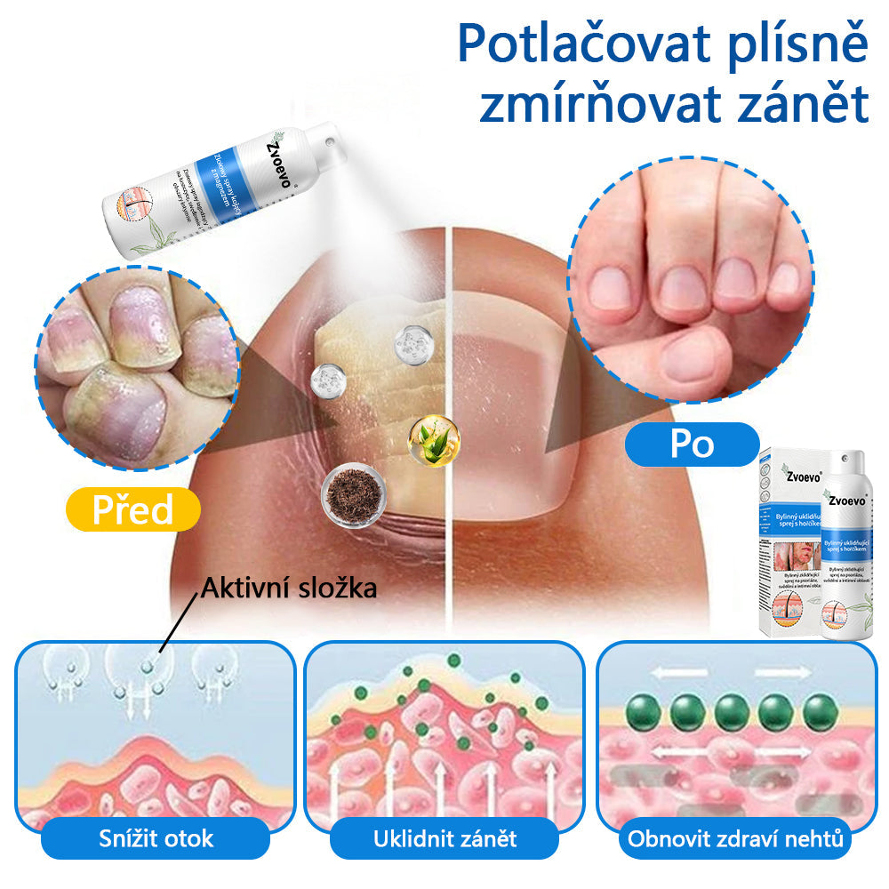 ✅ Oficiální obchod: Zvoevo® Magnesium bylinný sprej na lupénku ⚕️ EMA certifikace (zmírňuje lupénku a ekzém, léčí akné a bradavice, podporuje hojení bakteriálních infekcí, snižuje kloubní a neuropatickou bolest)