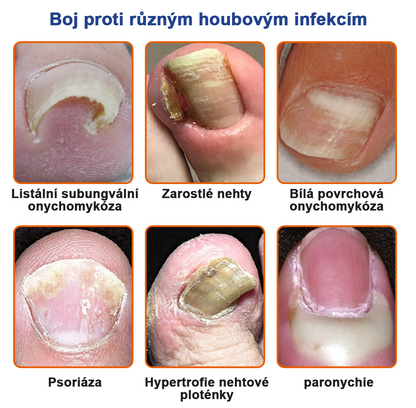 🐝Furzero™ Včelí jed na plíseň nehtů: kompletní řešení plísně nehtů 👣