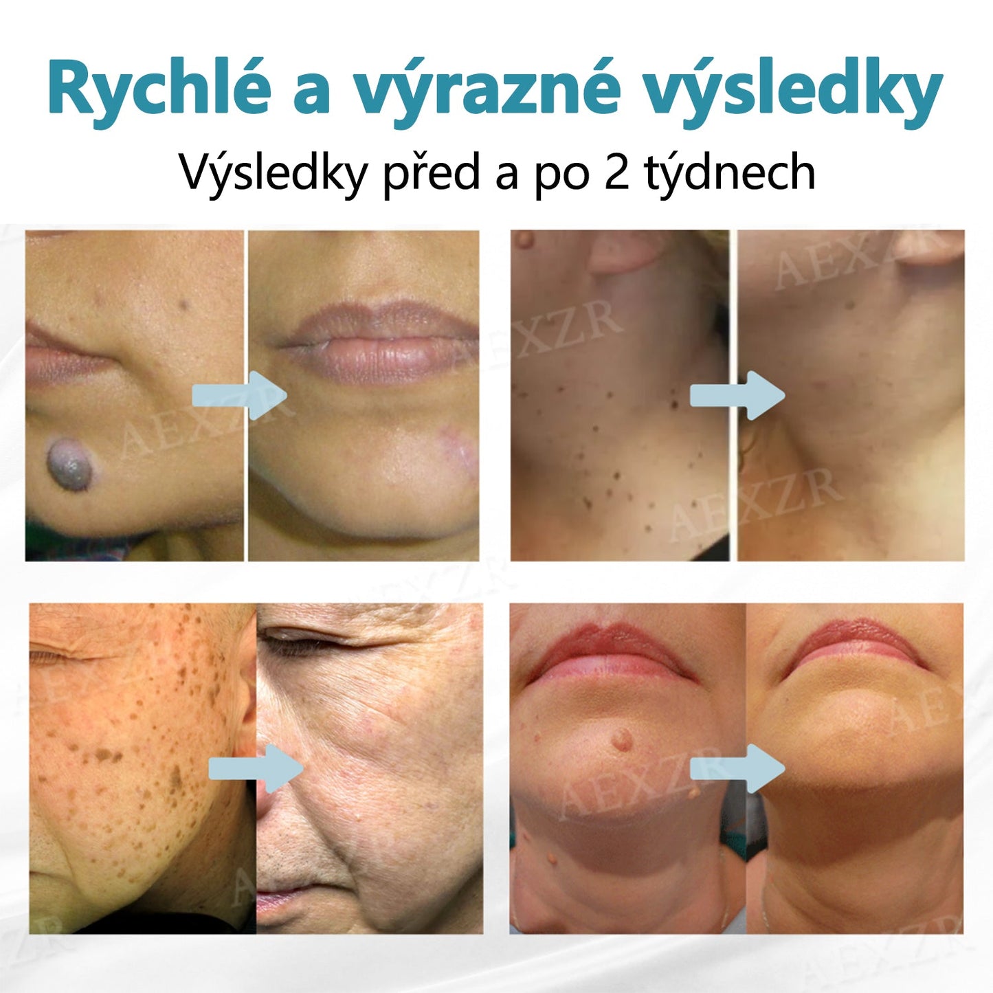 Foulme® PRO Neinvazivní laserové pero na odstraňování bradavic a znamének💎💎