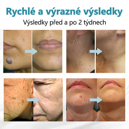 Foulme® PRO Neinvazivní laserové pero na odstraňování bradavic a znamének💎💎