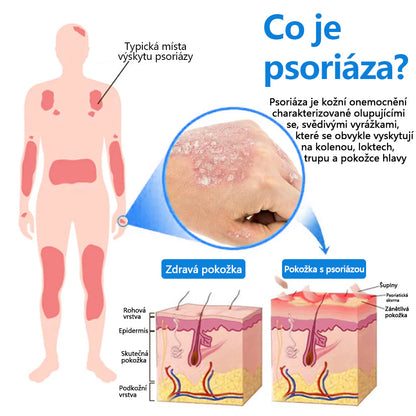✅ Oficiální obchod: Zvoevo® Magnesium bylinný sprej na lupénku ⚕️ EMA certifikace (zmírňuje lupénku a ekzém, léčí akné a bradavice, podporuje hojení bakteriálních infekcí, snižuje kloubní a neuropatickou bolest)