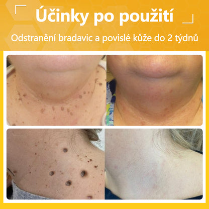 Twinsun™ Extra Silný Krém s včelím jedem, certifikovaný EMA💖 Na ošetření bradavic, kožních výrůstků, infekcí a keratózy, vyhlazuje nerovnoměrný povrch pokožky🐝