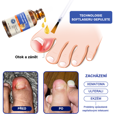 🐝Furzero™ Včelí jed na plíseň nehtů: kompletní řešení plísně nehtů 👣