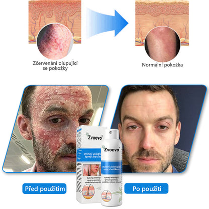 ✅ Oficiální obchod: Zvoevo® Magnesium bylinný sprej na lupénku ⚕️ EMA certifikace (zmírňuje lupénku a ekzém, léčí akné a bradavice, podporuje hojení bakteriálních infekcí, snižuje kloubní a neuropatickou bolest)