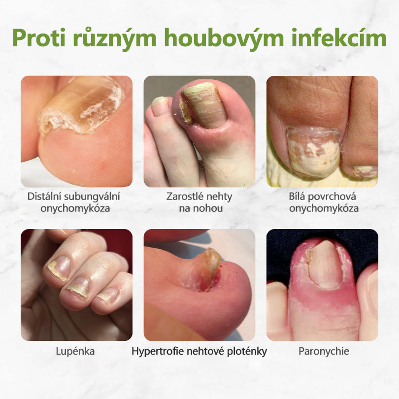 Biancat™ – přírodní roztok s včelím jedem proti plísni nehtů. Fakt pomáhá a je šetrný🐝👣