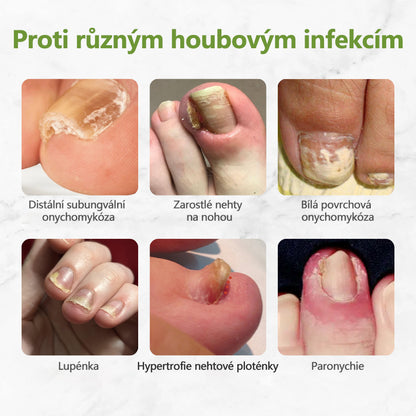 Biancat™ – přírodní roztok s včelím jedem proti plísni nehtů. Fakt pomáhá a je šetrný🐝👣