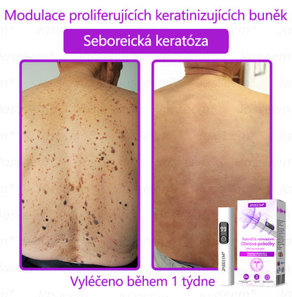 🌿𝐉𝐚𝐬𝐬𝐞𝐞𝐦® Pokročilé neinvazivní pero s CO₂ laserem na opravu pokožky 💕 (šetrně odstraňuje bradavice, mateřská znaménka, stařecké skvrny a kožní značky - bez bolesti a rozruchu!)🌿
