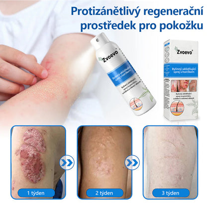 ✅ Oficiální obchod: Zvoevo® Magnesium bylinný sprej na lupénku ⚕️ EMA certifikace (zmírňuje lupénku a ekzém, léčí akné a bradavice, podporuje hojení bakteriálních infekcí, snižuje kloubní a neuropatickou bolest)