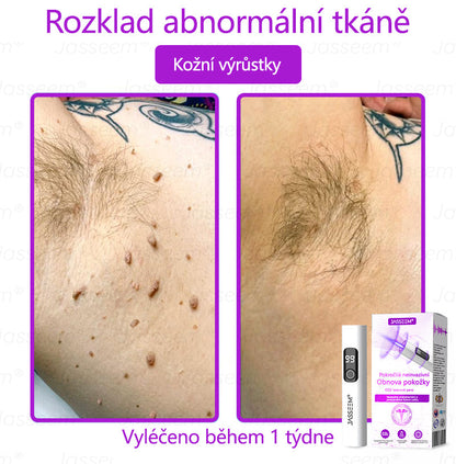 🌿𝐉𝐚𝐬𝐬𝐞𝐞𝐦® Pokročilé neinvazivní pero s CO₂ laserem na opravu pokožky 💕 (šetrně odstraňuje bradavice, mateřská znaménka, stařecké skvrny a kožní značky - bez bolesti a rozruchu!)🌿